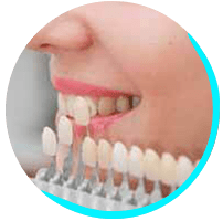 Facette dentaire